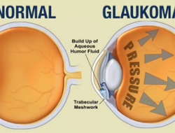 gloukoma